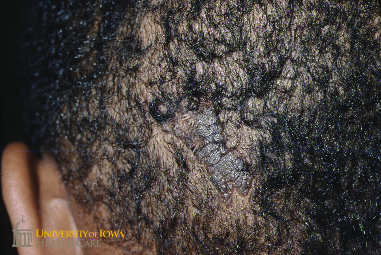 Linear brown-gray verrucous plaque on the scalp. (click images for higher resolution).